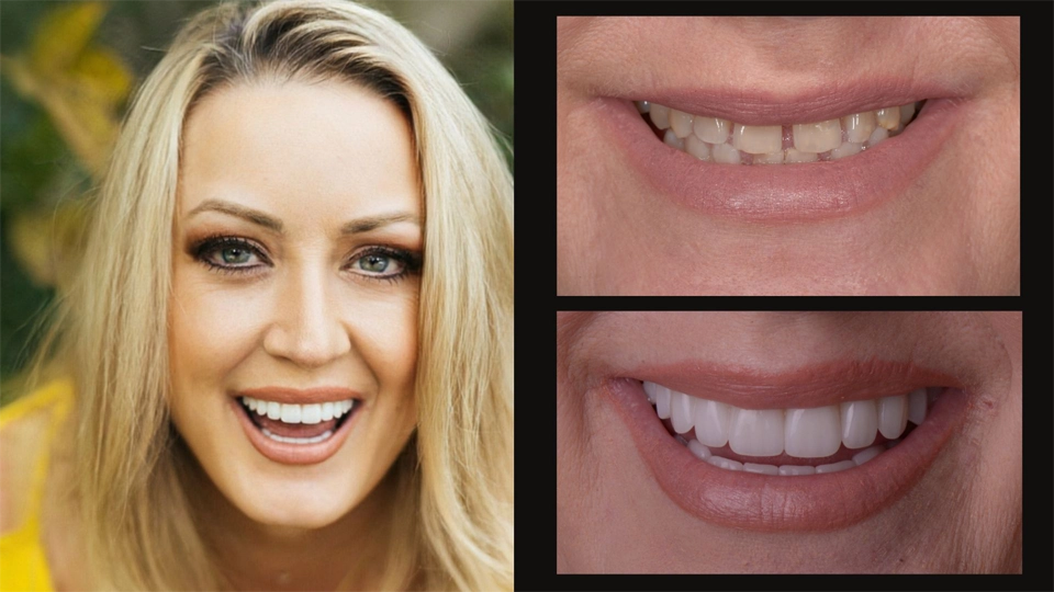 Porcelain Veneers in Arlington TX | Envision Dental Spa