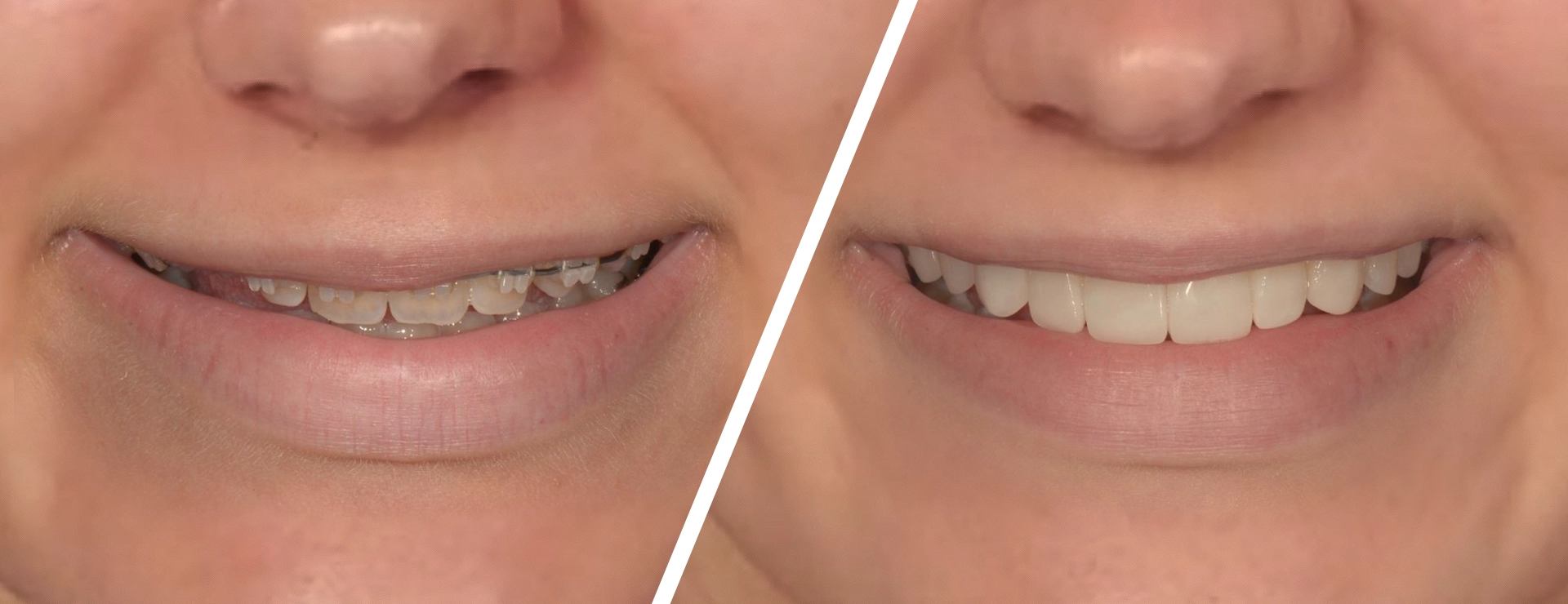 Is Composite Bonding Worth the Money?