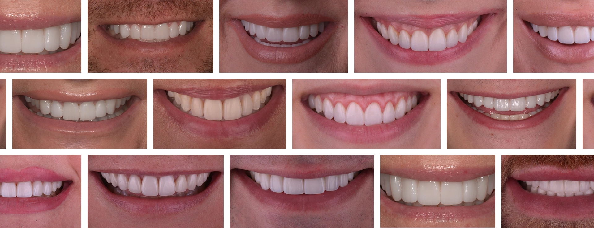 What Happens After 20 Years of Porcelain Veneers?
