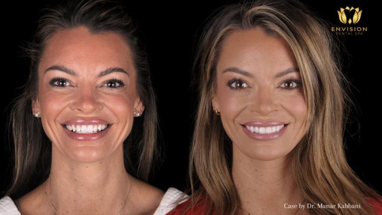 Smile preview example