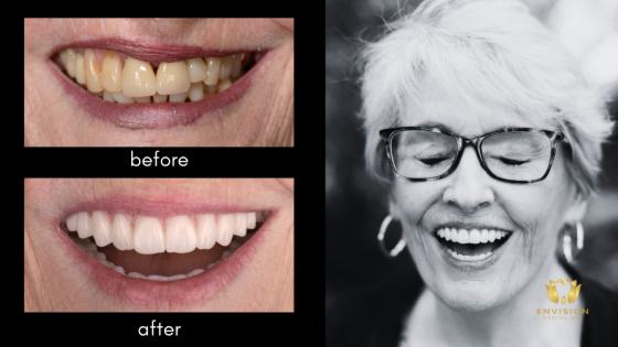 How Much Do Veneers Cost Per Tooth in 2026?