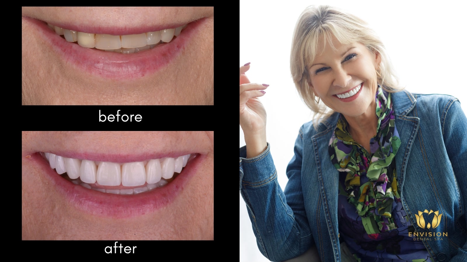 Full mouth rehabilitation case 1: before and after smile close-ups beside a portrait