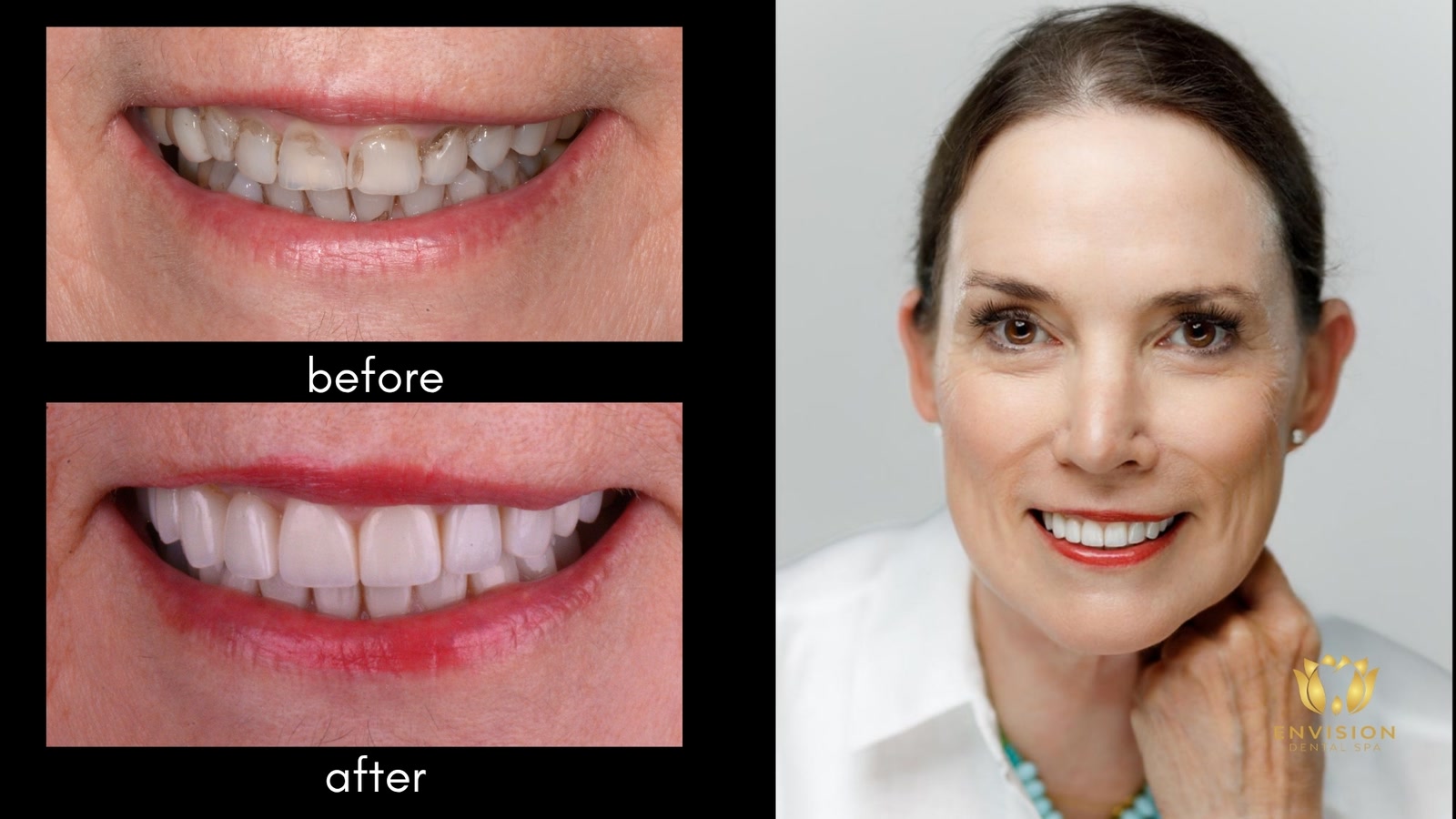 Full mouth rehabilitation case 2: before and after smile close-ups beside a portrait