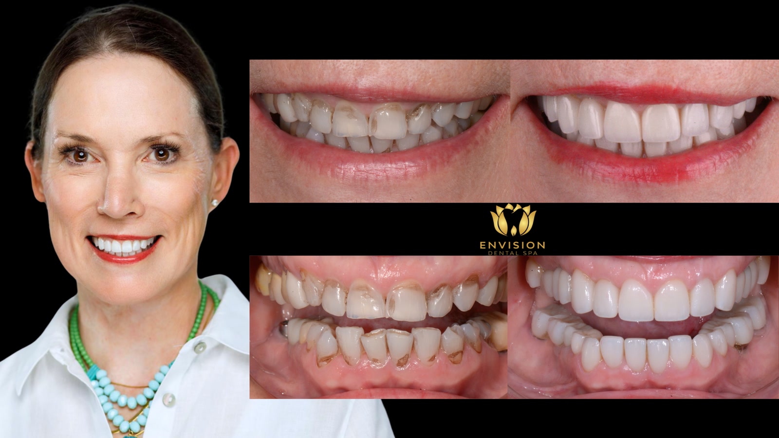 Full mouth rehabilitation case 2, more views: portrait with before and after photos of the smile and teeth