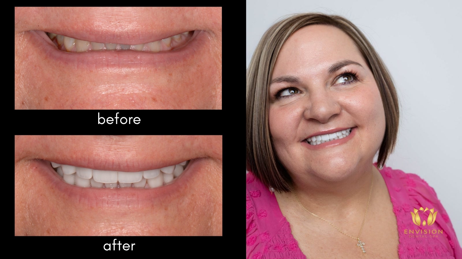 Full mouth rehabilitation case 3: before and after smile close-ups beside a portrait