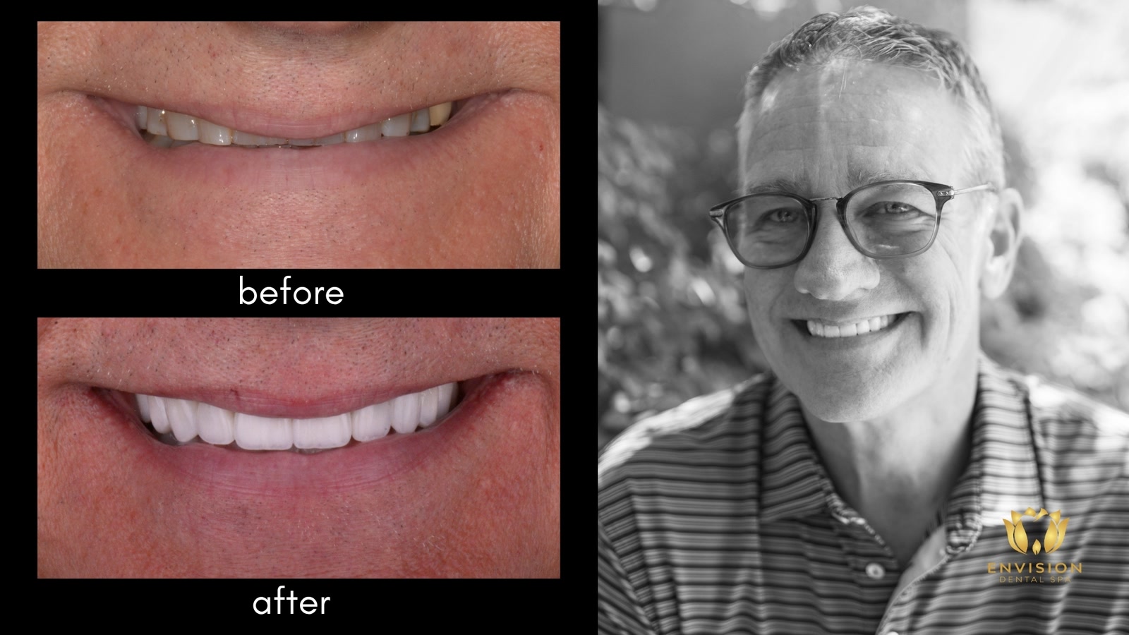 Full mouth rehabilitation case 4: before and after smile close-ups beside a portrait