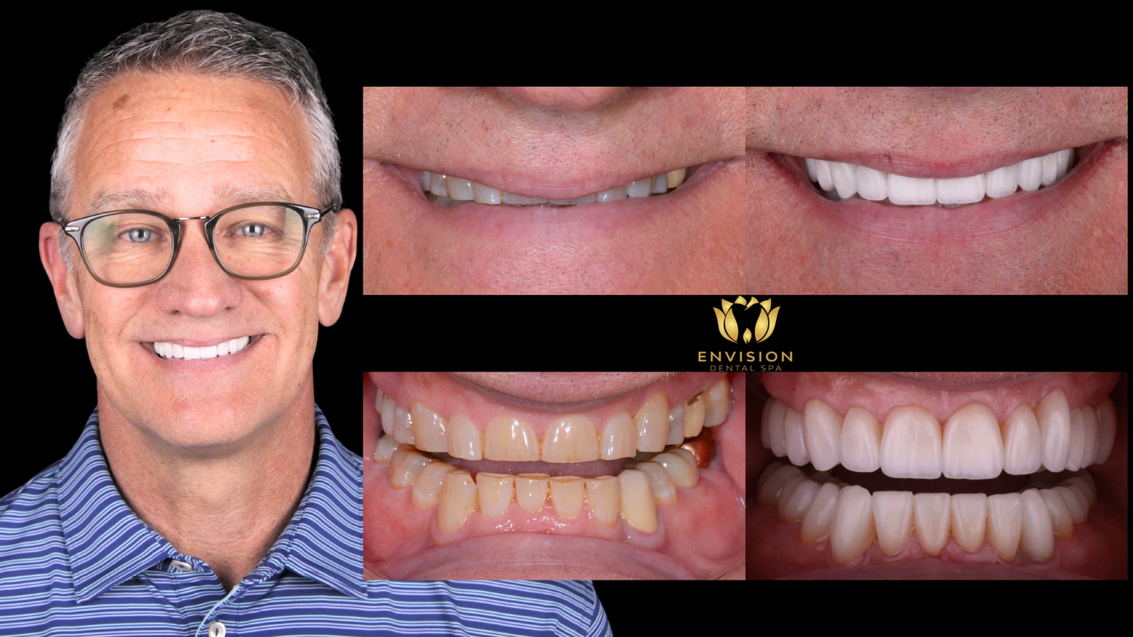 Full mouth rehabilitation case 4, more views: portrait with before and after photos of the smile and teeth