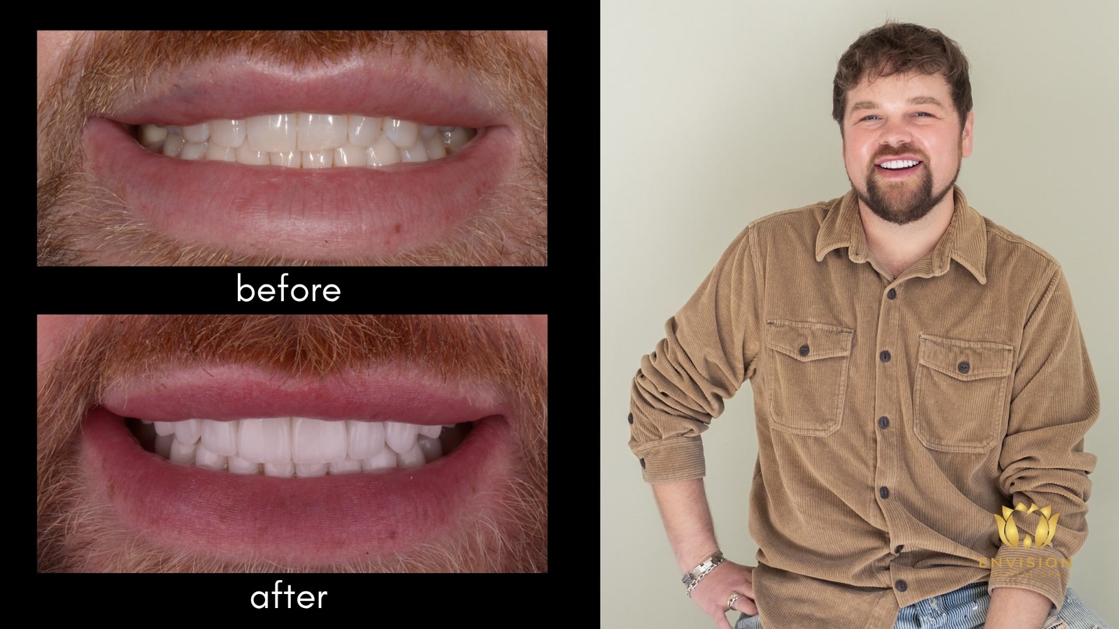 Full mouth rehabilitation case 5: before and after smile close-ups beside a portrait