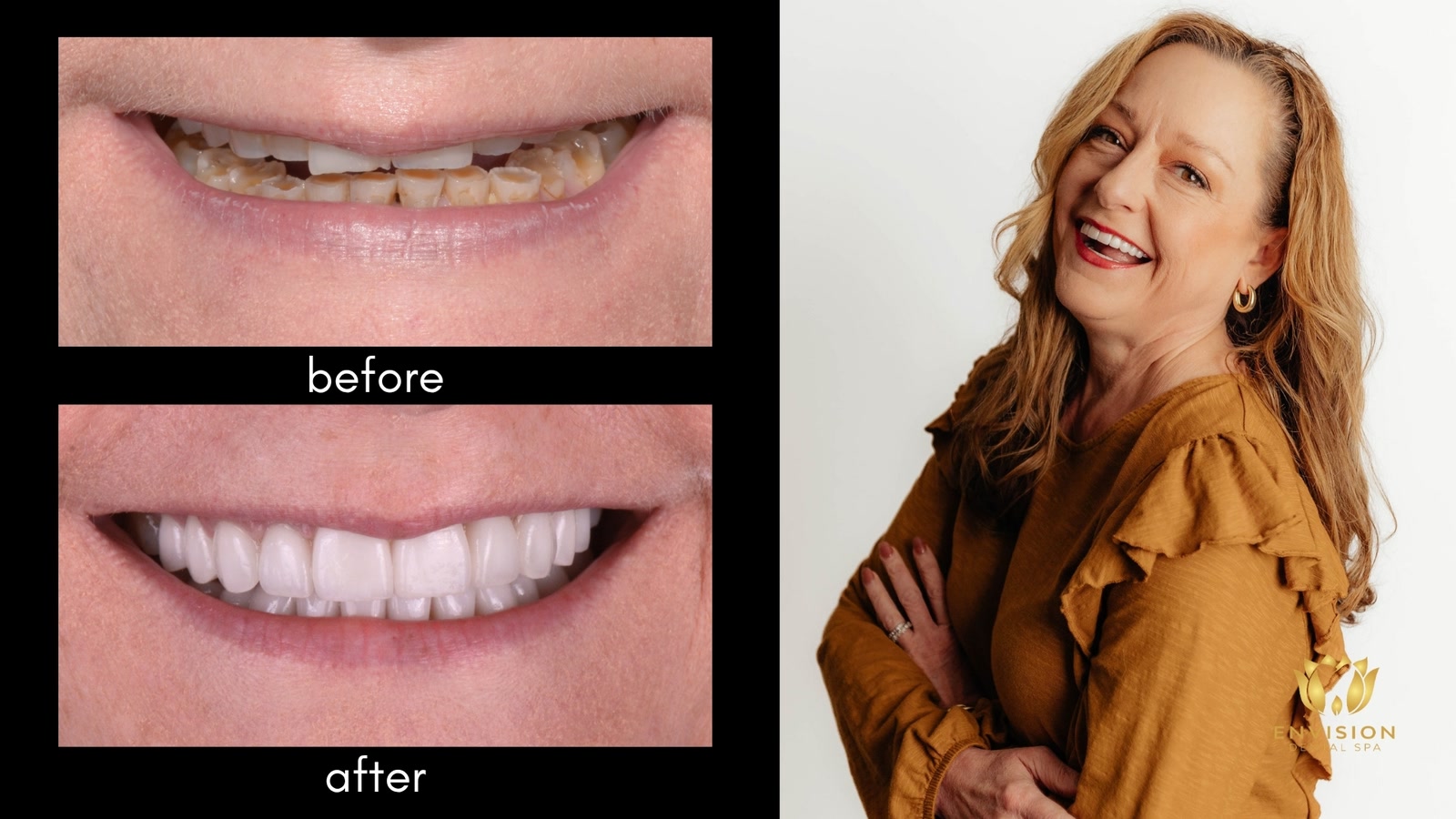 Full mouth rehabilitation case 6: before and after smile close-ups beside a portrait
