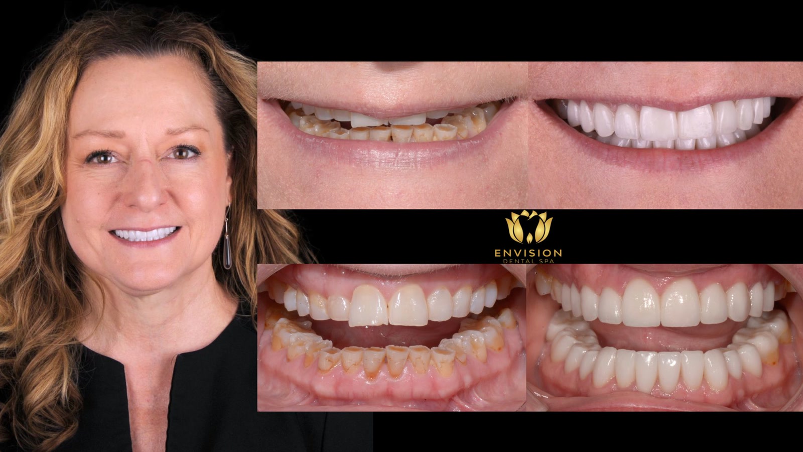 Full mouth rehabilitation case 6, more views: portrait with before and after photos of the smile and teeth