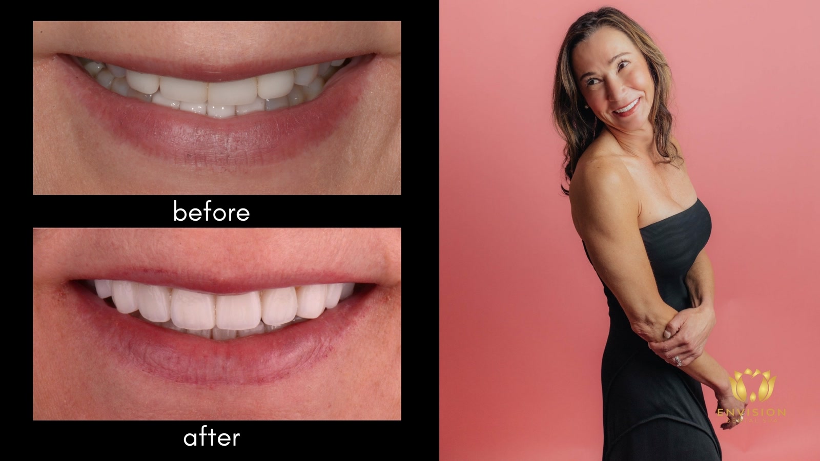 Full mouth rehabilitation case 7: before and after smile close-ups beside a portrait