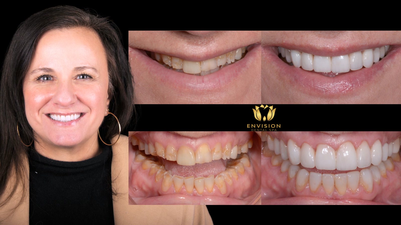 Full mouth rehabilitation case 8: portrait with before and after photos of the smile and teeth